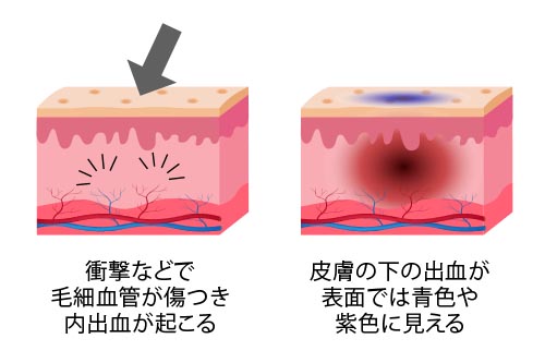 トリートメント後にあざができる人は Srotas スロータス